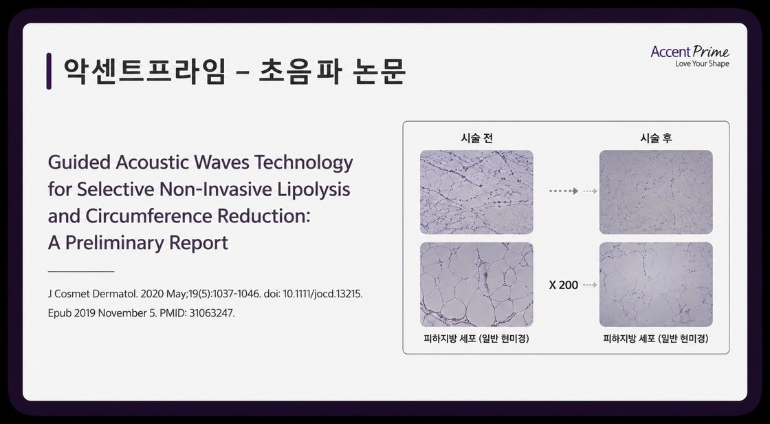 악센트프라임 초음파 관련 논문 표지