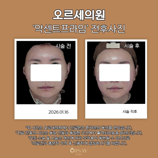 악센트프라임 전후사진 2026.01.16