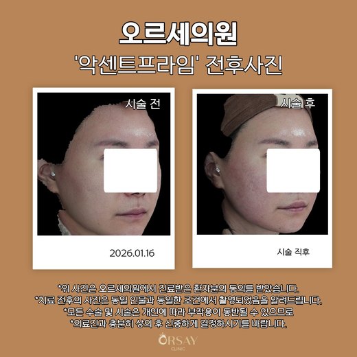 악센트프라임 전후사진 2026.01.16