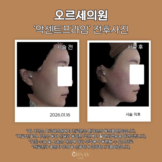 악센트프라임 전후사진 2026.01.16