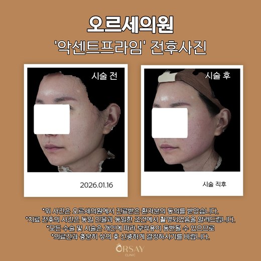 악센트프라임 전후사진 2026.01.16
