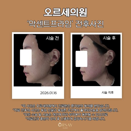 악센트프라임 전후사진 2026.01.16