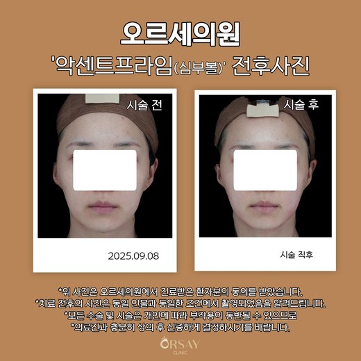 환자 A 악센트프라임(심부볼) 시술 전후사진 정면, 2025.09.08