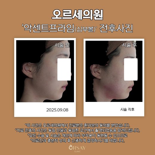 환자 A 악센트프라임(심부볼) 시술 전후사진 측면(오른쪽), 2025.09.08
