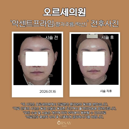 환자 B 악센트프라임(팔자주름·턱선) 시술 전후사진 정면, 2026.01.16