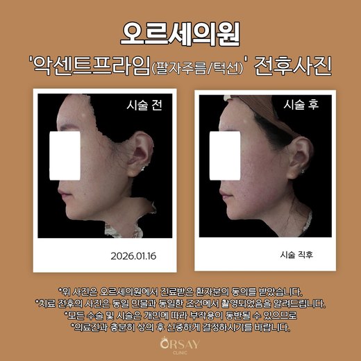 환자 B 악센트프라임(팔자주름·턱선) 시술 전후사진 측면(오른쪽), 2026.01.16
