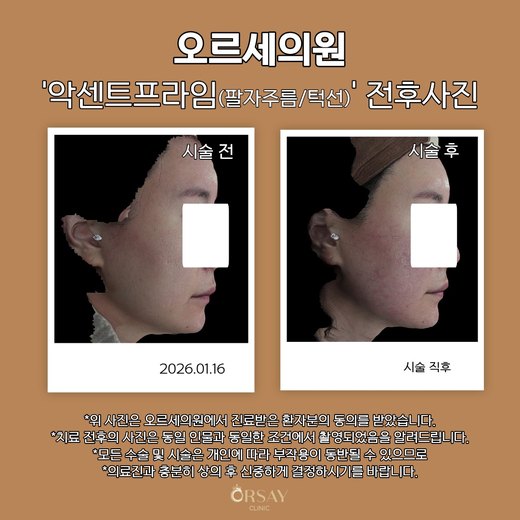 환자 B 악센트프라임(팔자주름·턱선) 시술 전후사진 측면(왼쪽), 2026.01.16