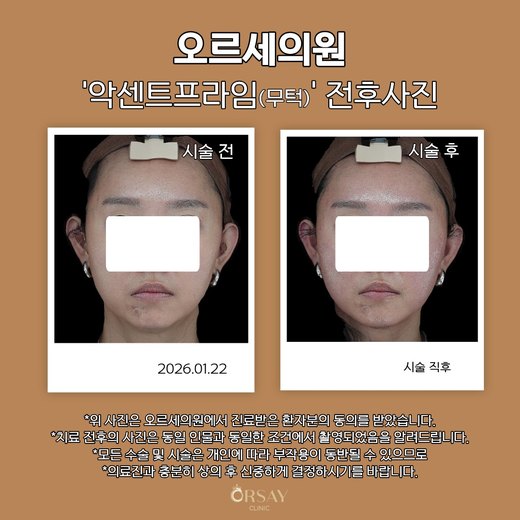 환자 C 악센트프라임(무턱) 시술 전후사진 정면, 2026.01.22