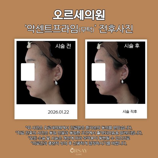환자 C 악센트프라임(무턱) 시술 전후사진 측면(오른쪽), 2026.01.22