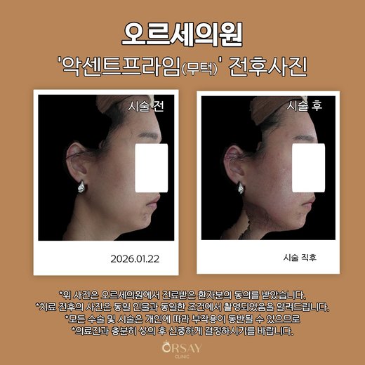 환자 C 악센트프라임(무턱) 시술 전후사진 측면(왼쪽), 2026.01.22