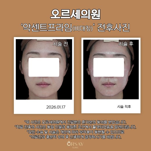 환자 D 악센트프라임(비대칭) 시술 전후사진 정면, 2026.01.17