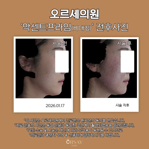 환자 D 악센트프라임(비대칭) 시술 전후사진 측면(오른쪽), 2026.01.17