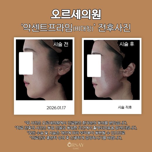 환자 D 악센트프라임(비대칭) 시술 전후사진 측면(왼쪽), 2026.01.17