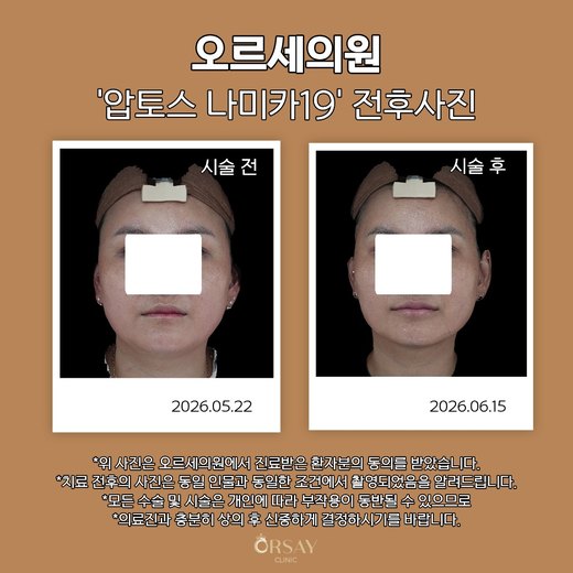 압토스 나미카19 시술 전후 정면 사진 2026.05.22, 2026.06.15