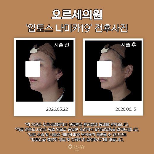 압토스 나미카19 시술 전후 45도 사진