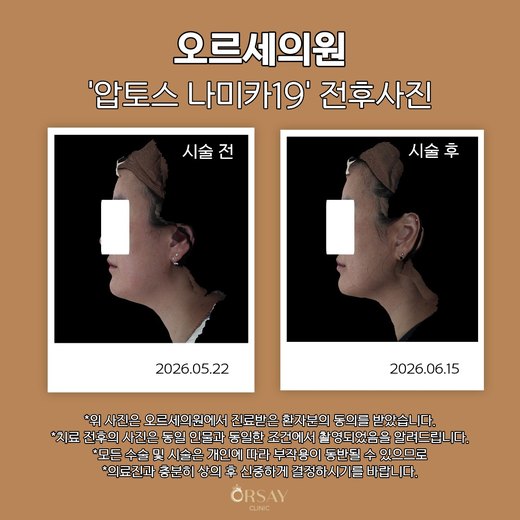 압토스 나미카19 시술 전후 측면 사진