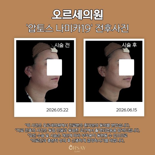 압토스 나미카19 시술 전후 45도 사진