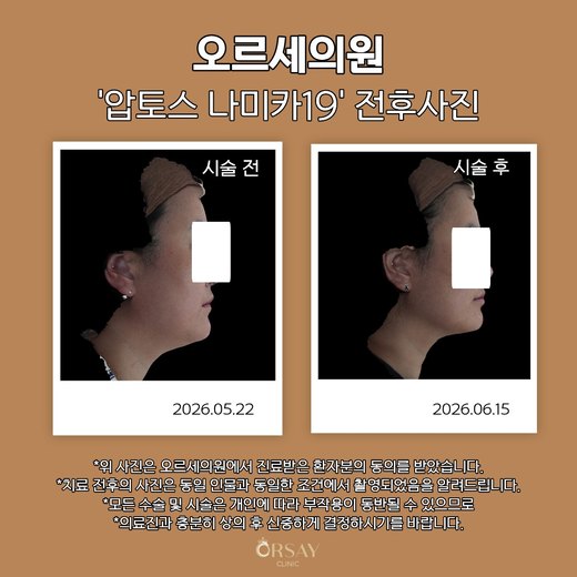 압토스 나미카19 시술 전후 측면 사진