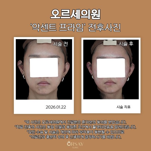 악센트프라임 전후사진