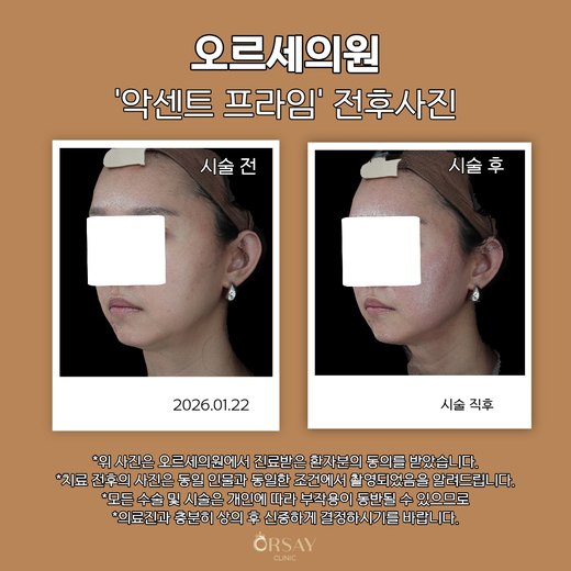 악센트프라임 전후사진