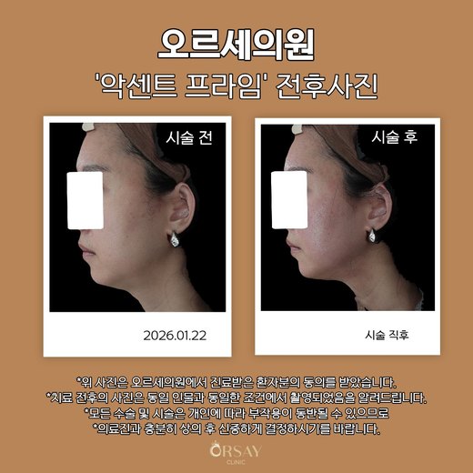 악센트프라임 전후사진