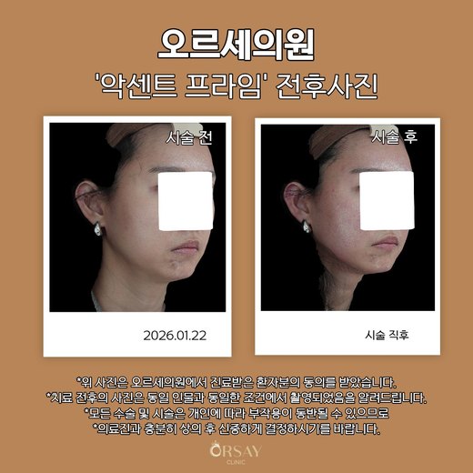 악센트프라임 전후사진