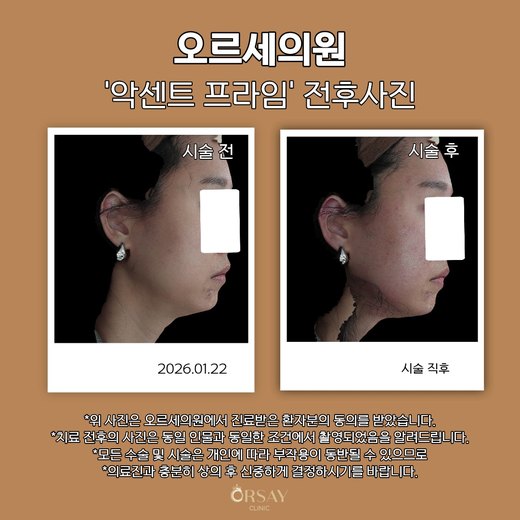 악센트프라임 전후사진