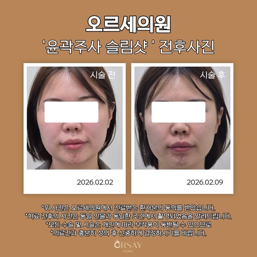윤곽주사 슬림샷 시술 전과 1주 후 정면 사진, 2026.02.02와 2026.02.09