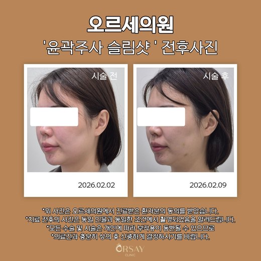윤곽주사 슬림샷 시술 전과 1주 후 45도 측면 사진(왼쪽)