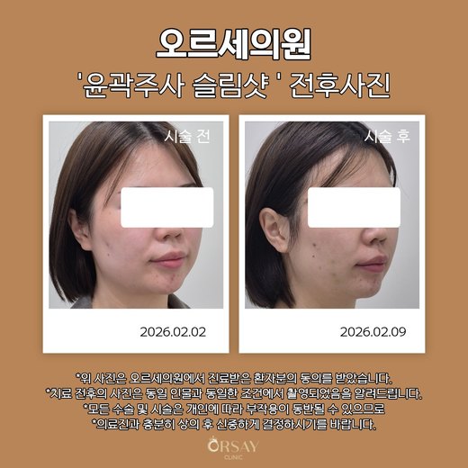 윤곽주사 슬림샷 시술 전과 1주 후 45도 측면 사진(오른쪽)