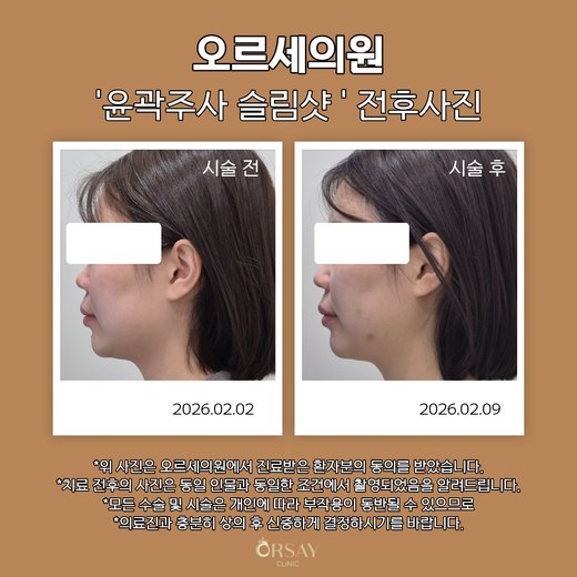 윤곽주사 슬림샷 시술 전과 1주 후 90도 측면 사진(왼쪽)