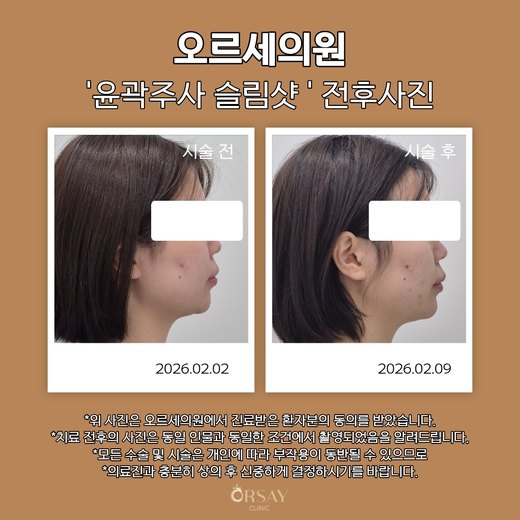 윤곽주사 슬림샷 시술 전과 1주 후 90도 측면 사진(오른쪽)