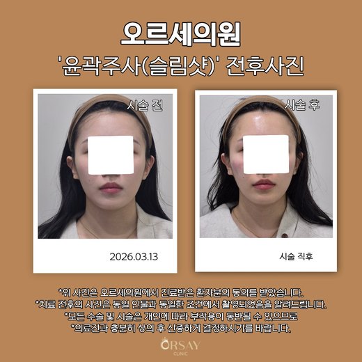 윤곽주사(슬림샷) 시술 전과 시술 직후 정면 사진 2026.03.13