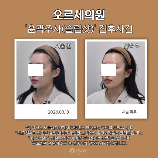윤곽주사(슬림샷) 시술 전과 시술 직후 45도 측면 사진 2026.03.13