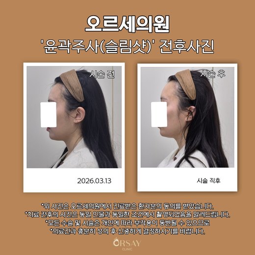 윤곽주사(슬림샷) 시술 전과 시술 직후 90도 측면 사진 2026.03.13