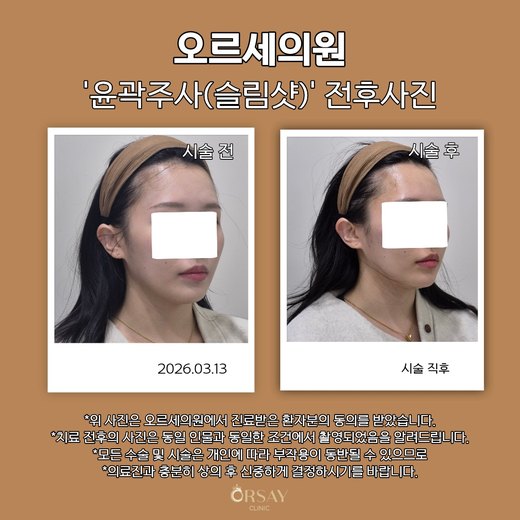 윤곽주사(슬림샷) 시술 전과 시술 직후 반대쪽 45도 측면 사진 2026.03.13