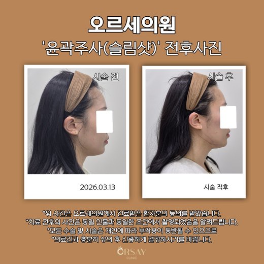 윤곽주사(슬림샷) 시술 전과 시술 직후 반대쪽 90도 측면 사진 2026.03.13
