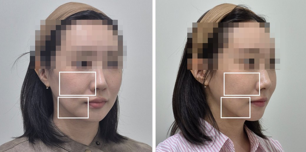 윤곽주사(슬림샷) 사례 1 전후사진 45도 측면, 왼쪽 시술 전 오른쪽 시술 10일 뒤