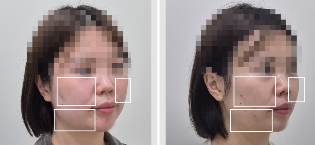 윤곽주사(슬림샷) 사례 2 전후사진 45도 측면, 왼쪽 시술 전 오른쪽 2회 시술 후