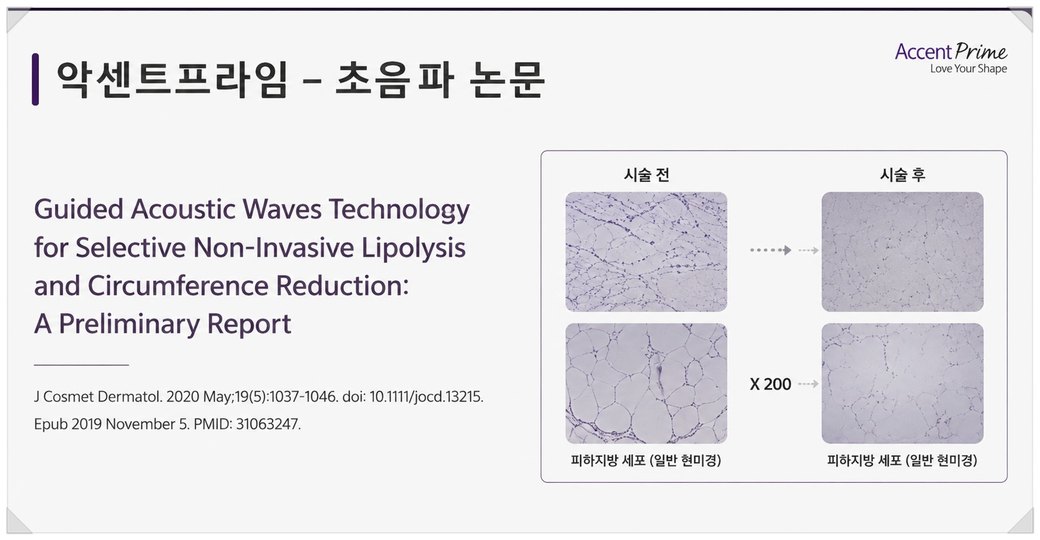 악센트프라임 초음파 논문 표지와 시술 전후 피하지방 세포 현미경 사진