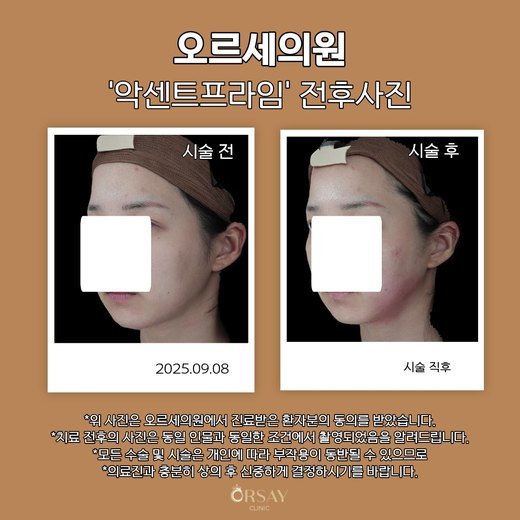 악센트프라임 시술 전과 시술 직후 45도 전후사진