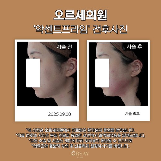 악센트프라임 시술 전과 시술 직후 측면 전후사진