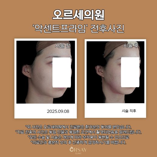 악센트프라임 시술 전과 시술 직후 45도 전후사진