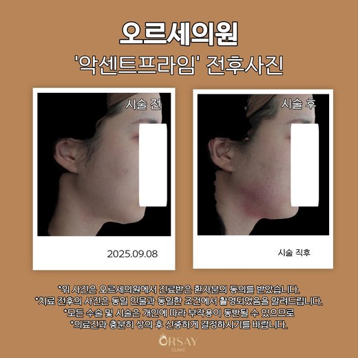 악센트프라임 시술 전과 시술 직후 측면 전후사진