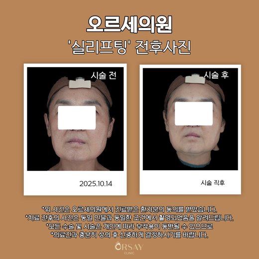실리프팅 전후사진