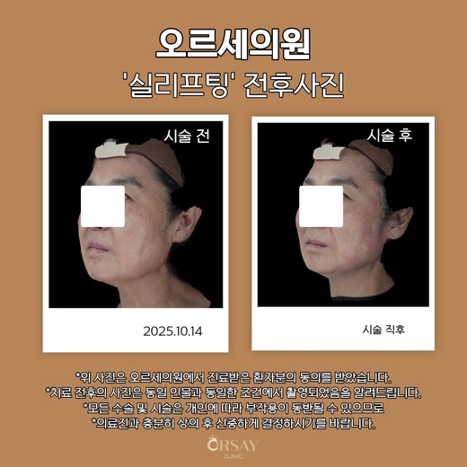 실리프팅 전후사진