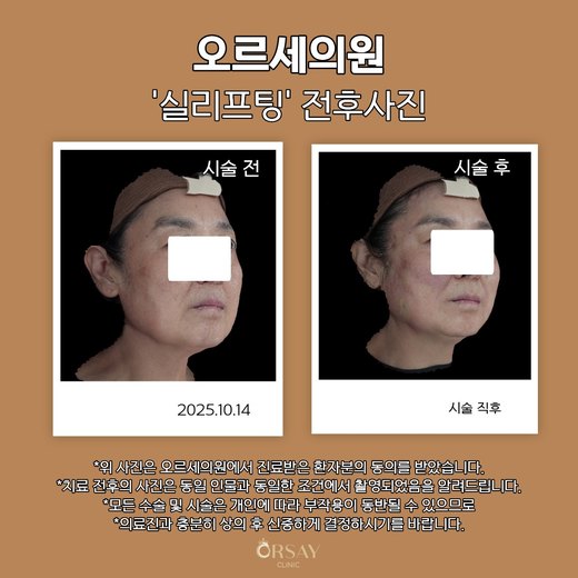 실리프팅 전후사진