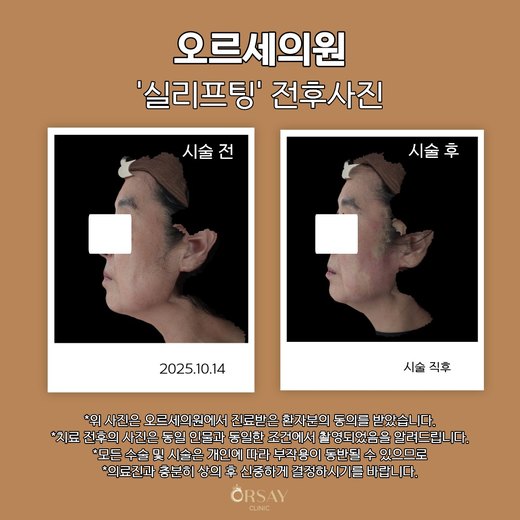 실리프팅 전후사진