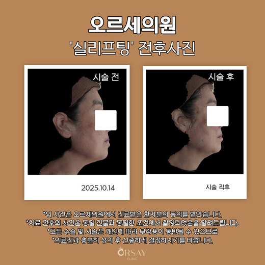 실리프팅 전후사진