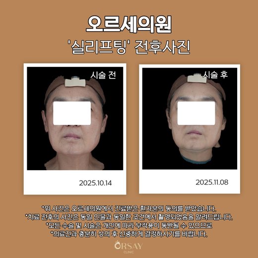 실리프팅 전후사진